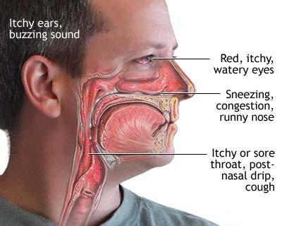 Allergy Diagram